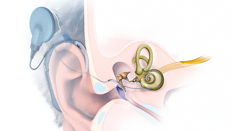 O que é e para que serve o implante coclear?